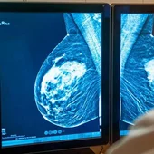 Johana, de 26 años, fue diagnosticada de cáncer de mama Johana, de 26 años, fue diagnosticada de cáncer de mama