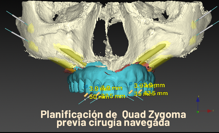 El Dr. Rubén Davó, del Hospital Vithas Medimar, lidera el primer estudio que avala el 'Quad Zygoma' como la solución definitiva para implantes maxilares fallidos El Dr. Rubén Davó, del Hospital Vithas Medimar, lidera el primer estudio que avala el 'Quad Zygoma' como la solución definitiva para implantes maxilares fallidos