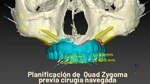 El Dr. Rubén Davó, del Hospital Vithas Medimar, lidera el primer estudio que avala el 'Quad Zygoma' como la solución definitiva para implantes maxilares fallidos El Dr. Rubén Davó, del Hospital Vithas Medimar, lidera el primer estudio que avala el 'Quad Zygoma' como la solución definitiva para implantes maxilares fallidos