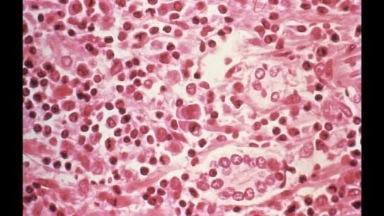 Imagen de una muestra tomada de un paciente sospechoso de Hantavirus/ Reuters