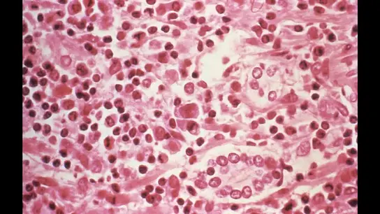 Imagen de una muestra tomada de un paciente sospechoso de Hantavirus Imagen de una muestra tomada de un paciente sospechoso de Hantavirus/ Reuters