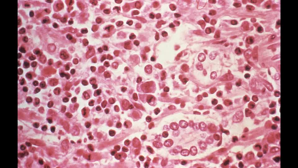 Síntomas del hantavirus y período de incubación Síntomas del hantavirus y período de incubación