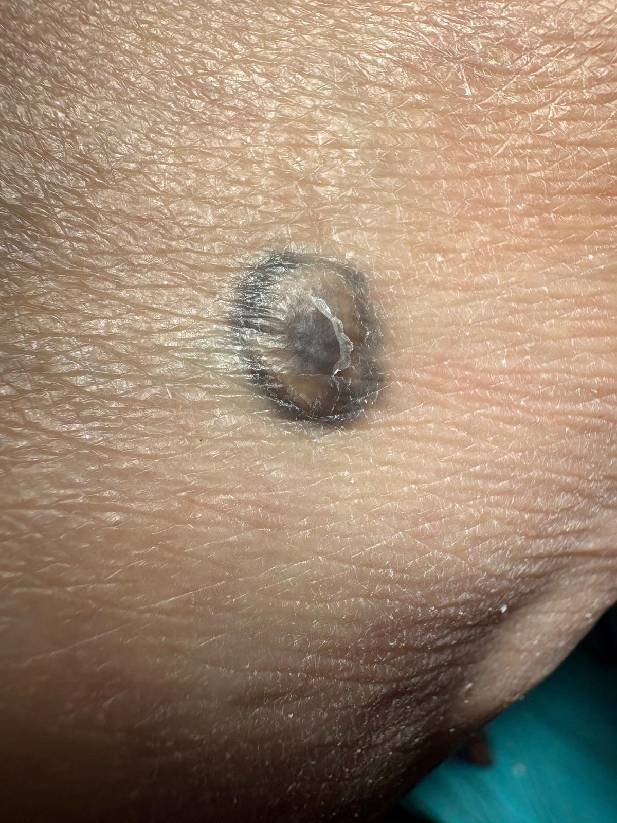 El Colegio Oficial de Podólogos de Castilla-La Mancha advierte de los casos de melanoma en pies y uñas El Colegio Oficial de Podólogos de Castilla-La Mancha advierte de los casos de melanoma en pies y uñas