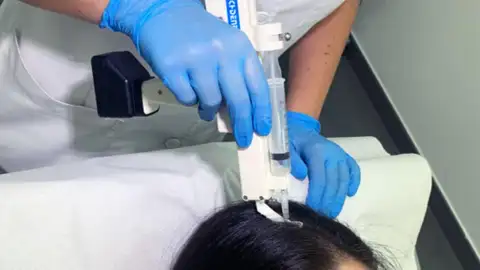 Alopecia Alopecia