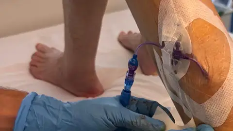 Implantación de un catéter femoral central de inserción periférica mediante técnica ecoguiada. Implantación de un catéter femoral central de inserción periférica mediante técnica ecoguiada.