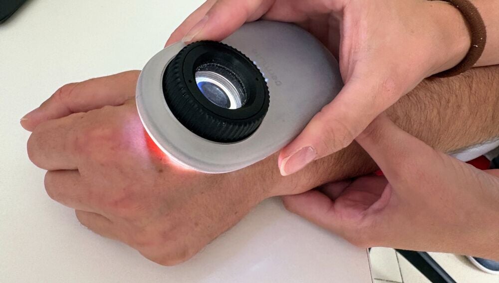 El Departamento de Salud de Orihuela refuerza la Teledermatología con la adquisición de dermatoscopios en sus centros de salud 