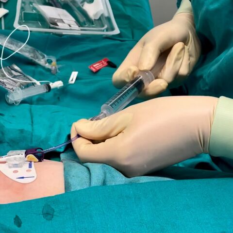 El Hospital General de Elche crea un equipo para mejorar el acceso vascular de pacientes hospitalizados y ambulatorios.